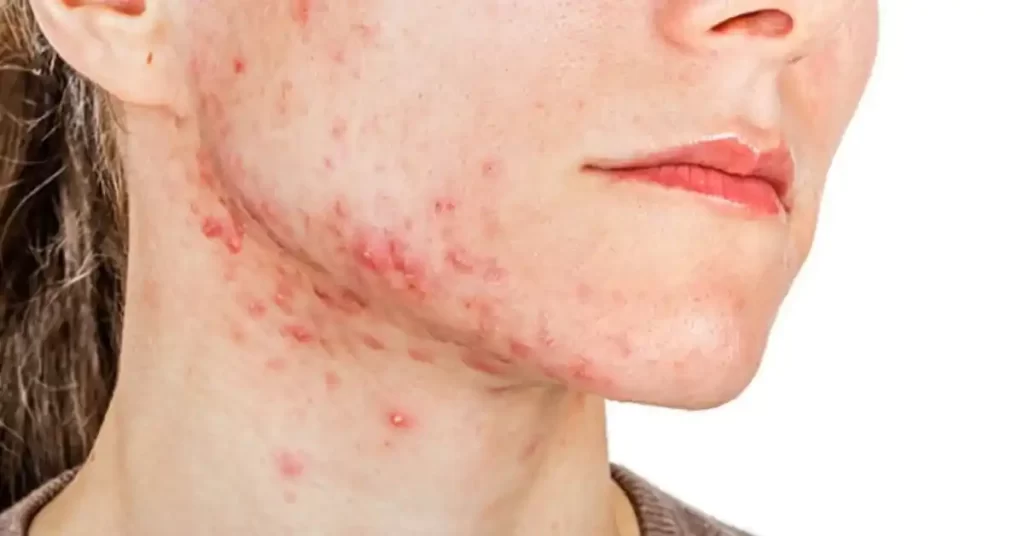 acne causes and diet plan