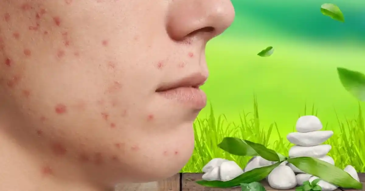acne causes and treatment